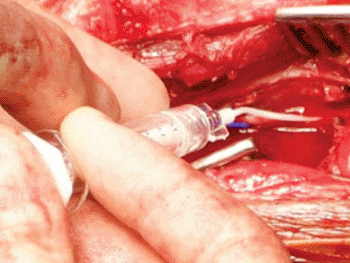Image: LeGoo being injected into a tibial bypass (Photo courtesy of Pluromed).